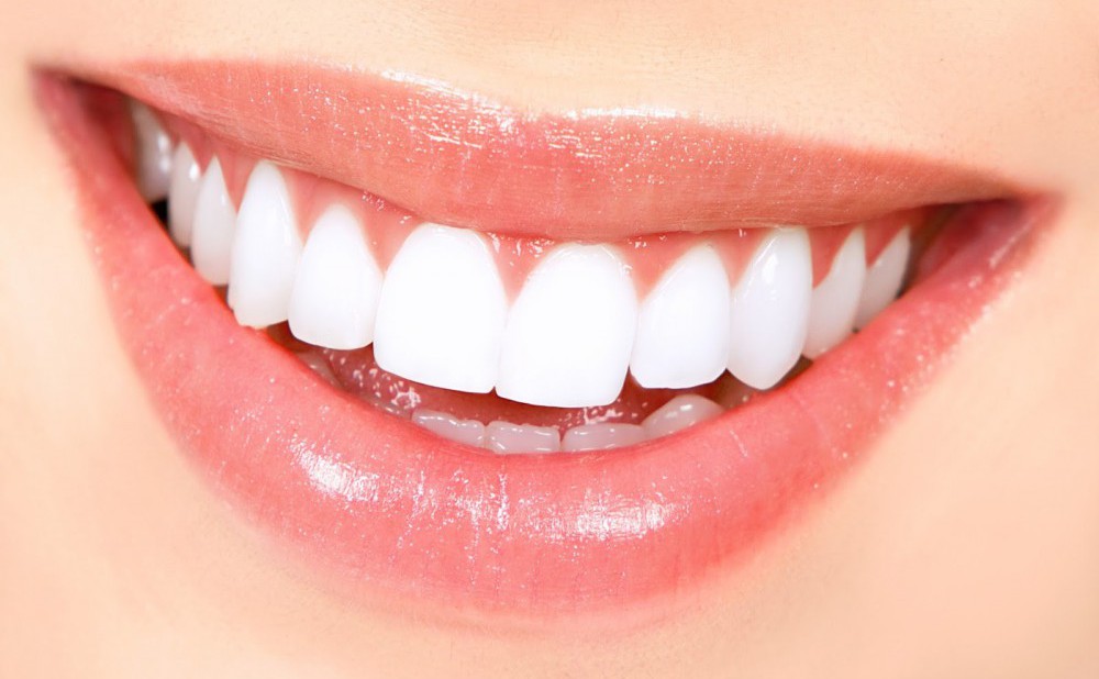 Todo lo que necesitas saber sobre las carillas dentales