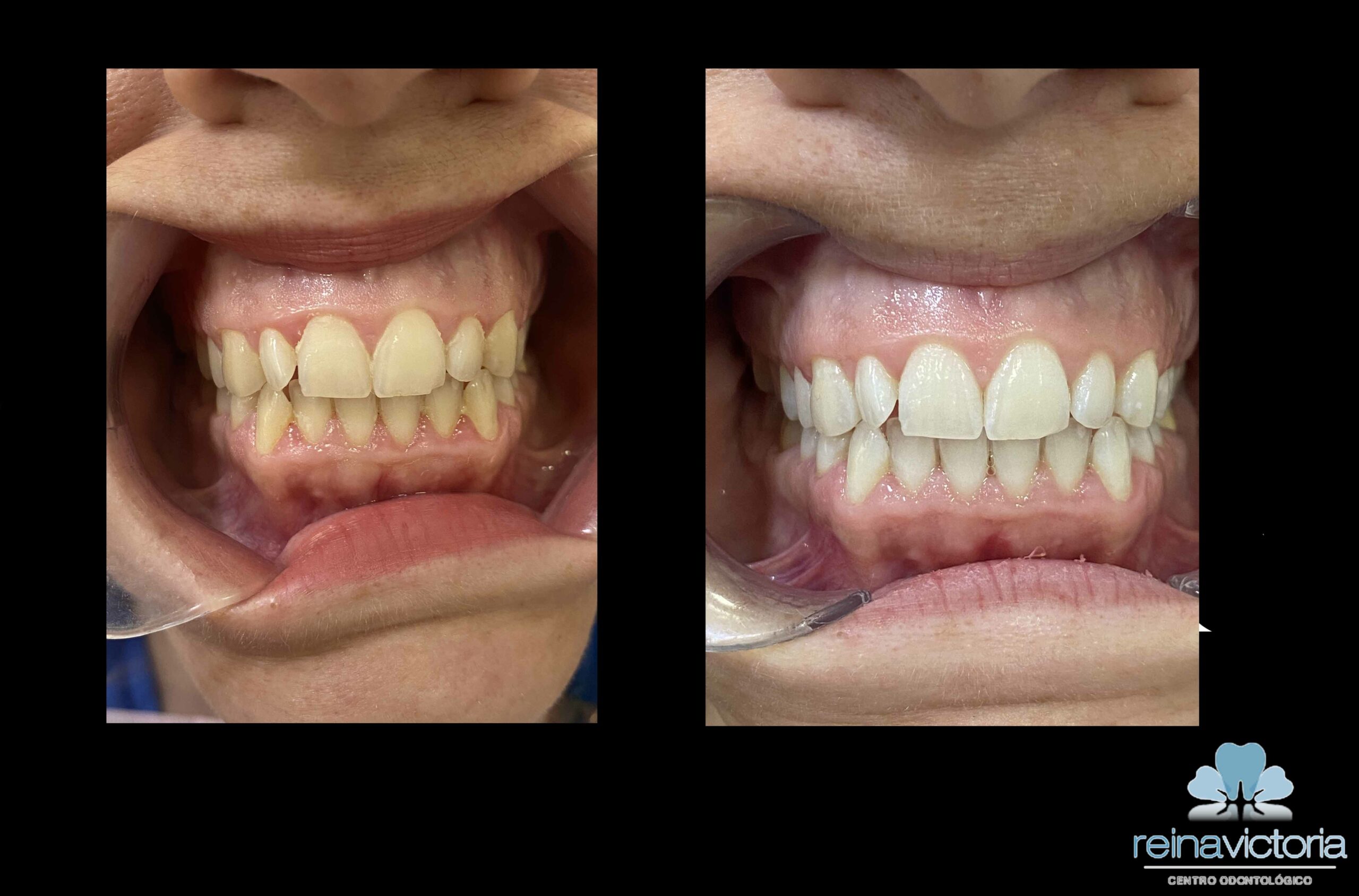 El blanqueamiento dental en la clínica: una sonrisa más brillante y confiada